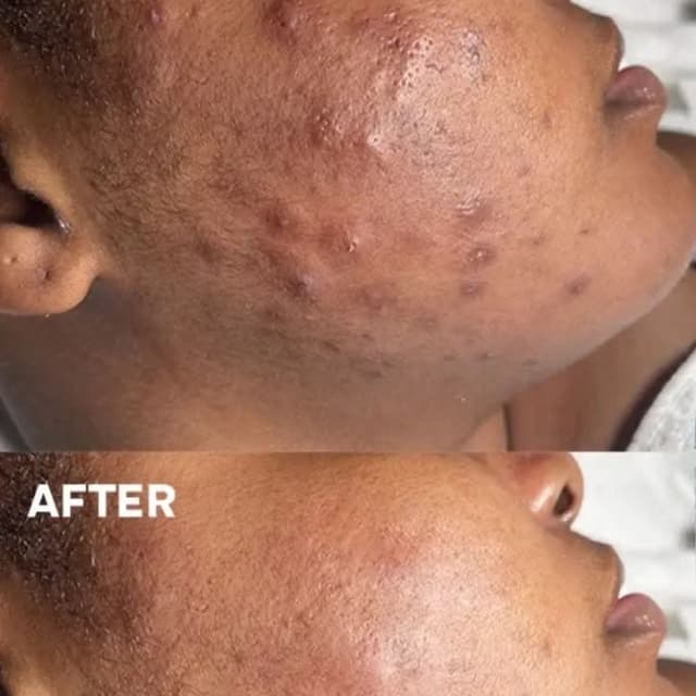 Acne Reset Facial Package at Étoile Briyan in Malden, MA
